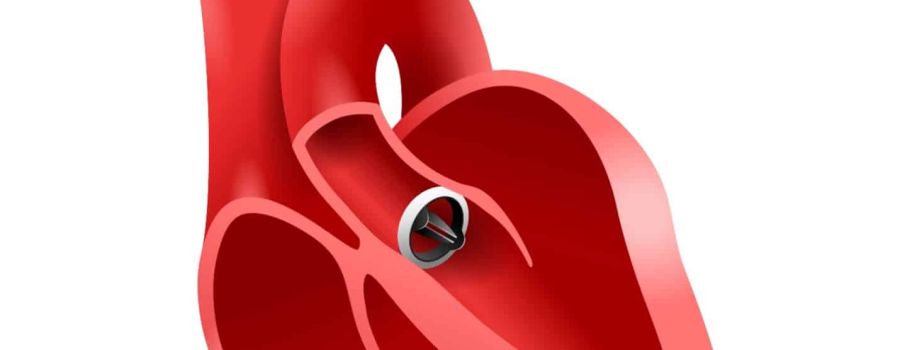 Heart Valve